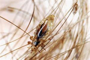 Lice and nit on hair 